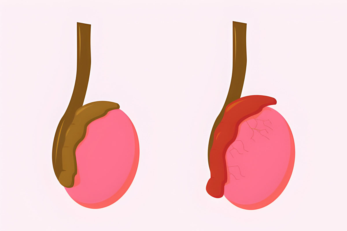 Epididim Hastalıkları Nelerdir?