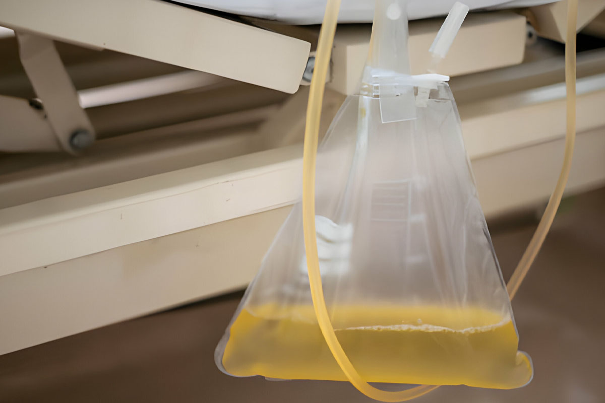 İdrar Kesesi Sarkması Sistosel Kaç Derecede Sınıflandırılır?