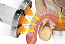 ESWT Şok Dalga tedavisi hasta memnuniyeti