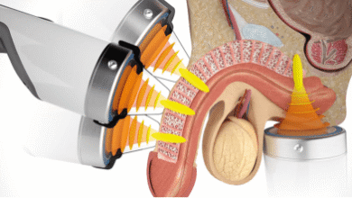 ESWT Şok Dalga tedavisi hasta memnuniyeti