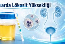 drarda lökosit yüksekliği için idrar tahlili, test çubuğu ve üriner sistem görseli